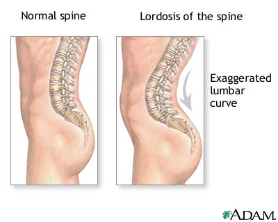 spine-hyperextension.jpg
