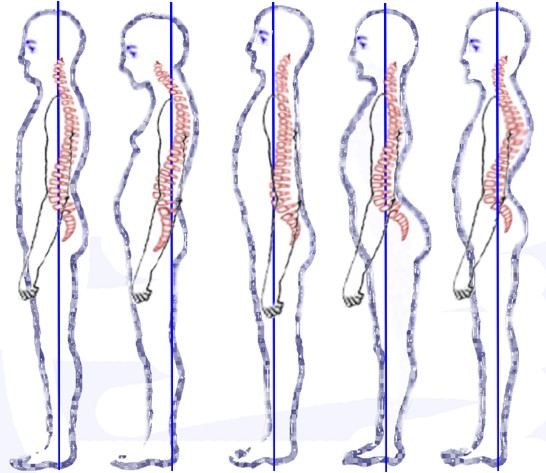 Posture_types_%28vertebral_column%29.jpg