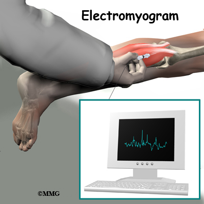 whiplash_emg.jpg
