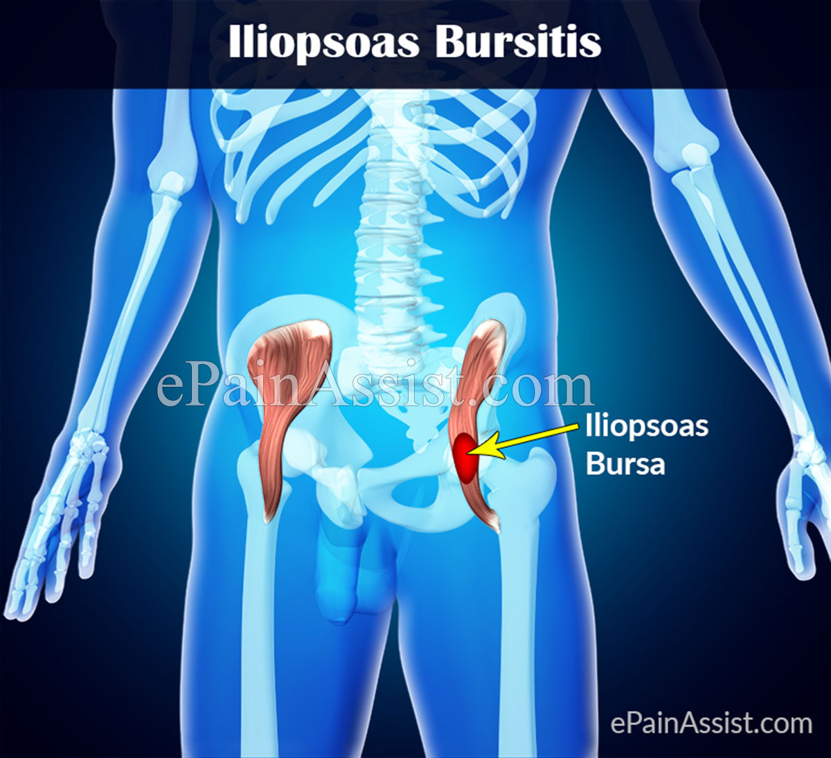 iliopsoas-bursitis.jpg