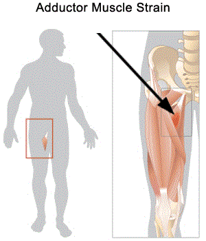 groin_pain2.gif